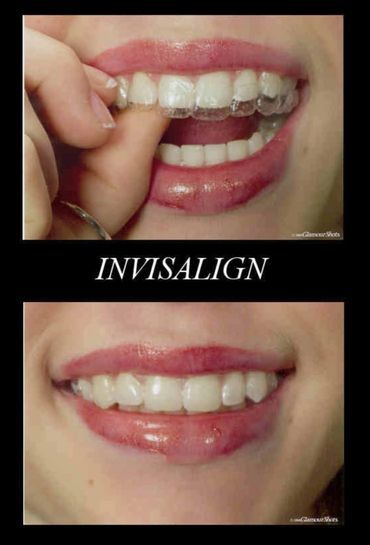 Before After image of invisalign procedure