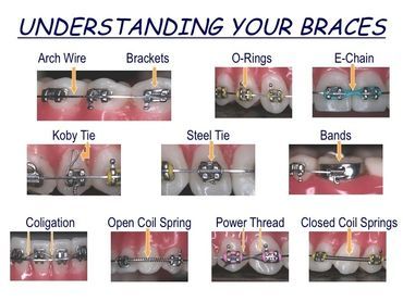 Stock image of Understanding your Braces Chart
