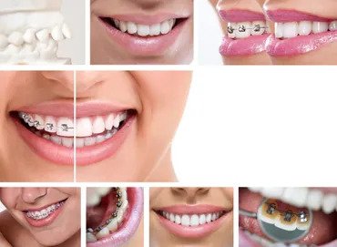 Benefits of orthodontics image