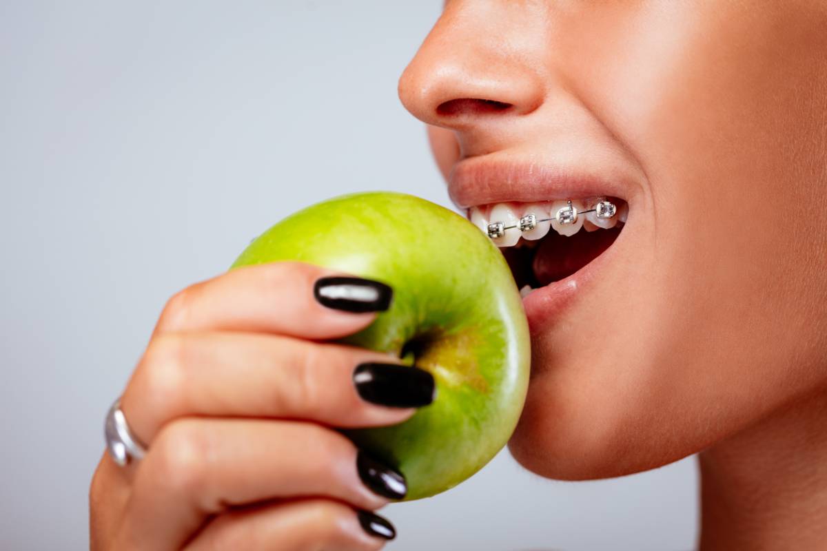 concept image of best foods to eat with braces